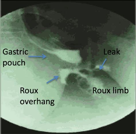 stomach leak symptoms|Anastomotic Leak